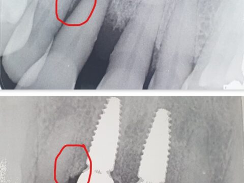 An example of bone loss around an implant.